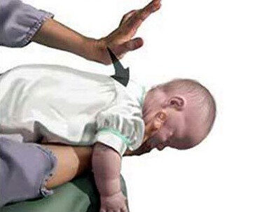 Cách sơ cứu trẻ dưới 1 tuổi