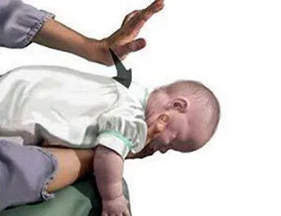 Cách sơ cứu khi trẻ bị hóc dị vật tại nhà